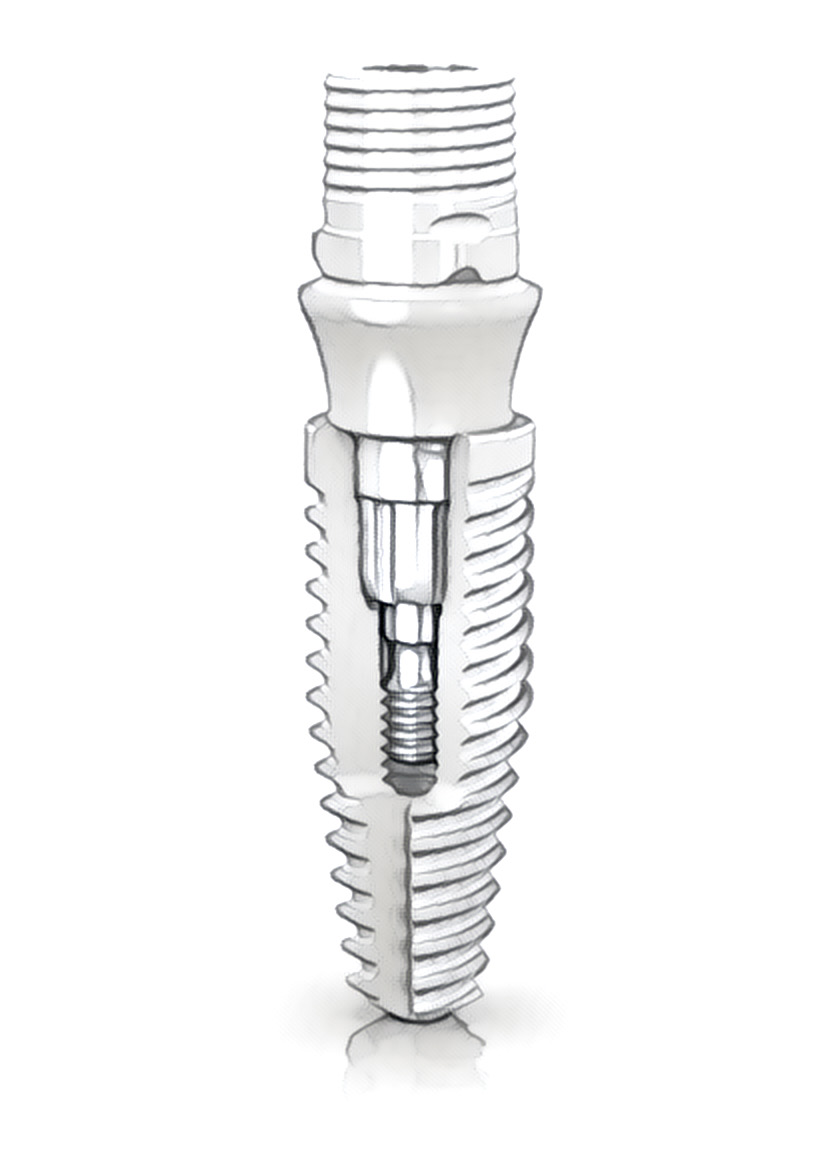 Neodent Zi Ceramic Implant